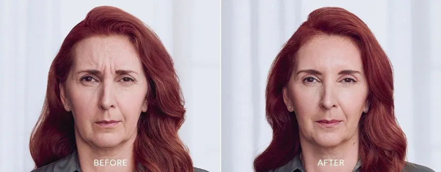 Botox Before and After — The Firm Medspa