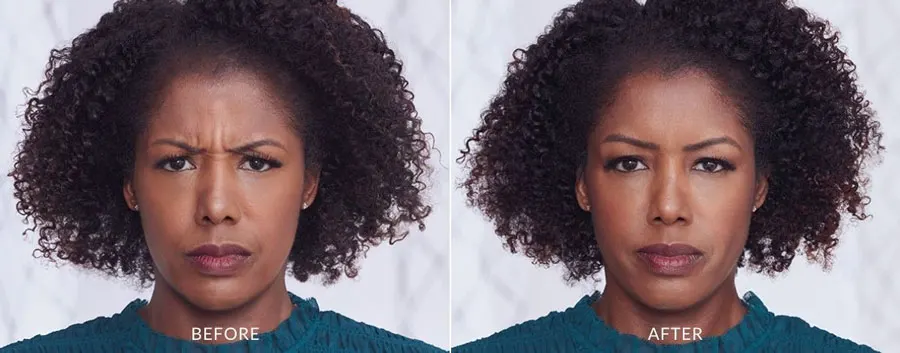 Botox Before and After — The Firm Medspa