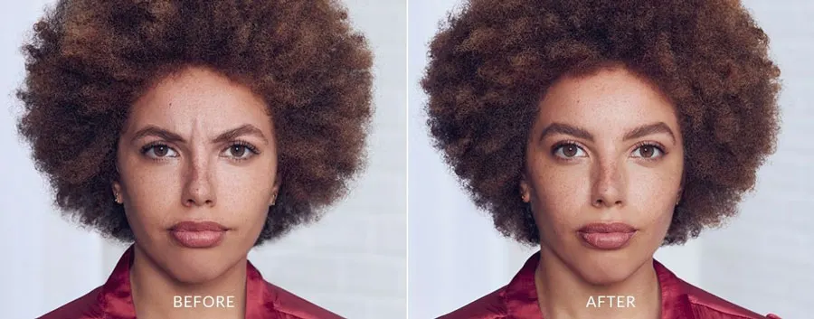 Botox Before and After — The Firm Medspa