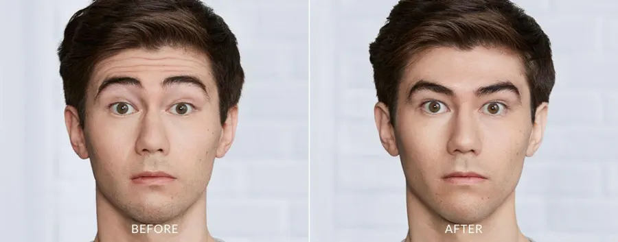 Botox Before and After — The Firm Medspa
