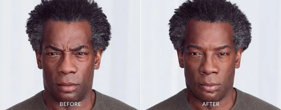 Botox Before and After — The Firm Medspa