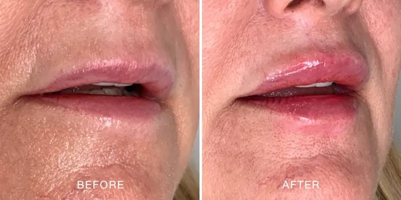 Lip filler before and after showing an increased in lip volume.