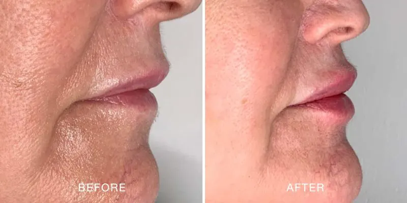 Lip filler before and after showing an increased in lip volume.