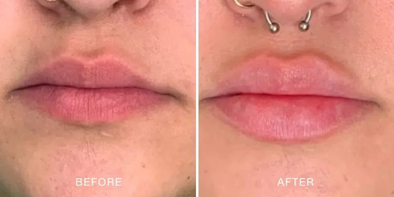 Lip filler before and after showing an increased in lip volume.