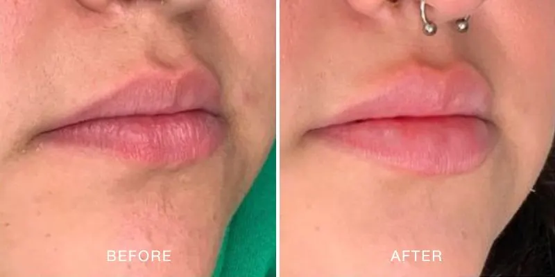 Lip filler before and after showing an increased in lip volume.