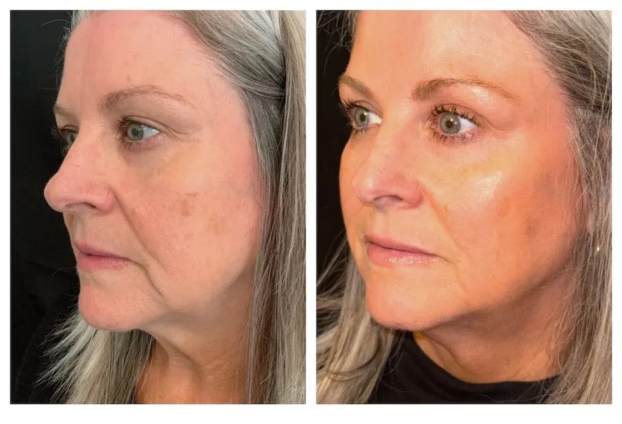 Emface Before and After