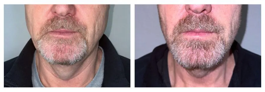 Emface Before and After