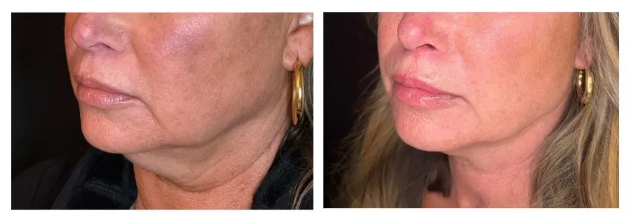 Emface Before and After