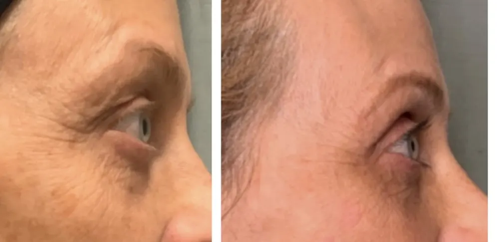Opus Skin Resurfacing Before & After 2