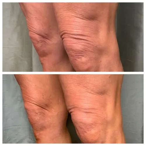 Skin Tightening Before & After 1